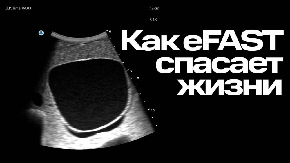 Как eFAST спасает жизни пациентов